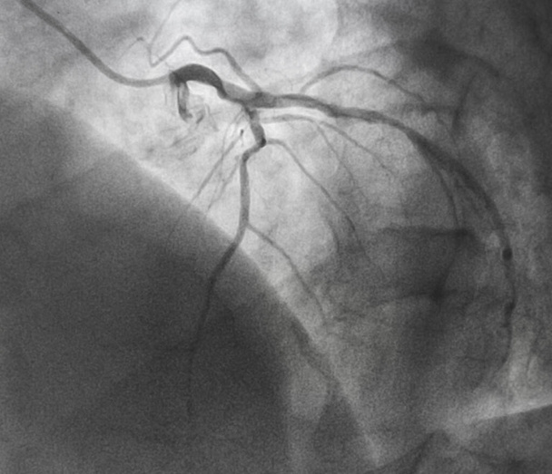 Angiografía coronaria, angiografía coronaria izquierda
 - Foto, imagen