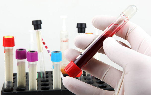 Coronavirus disease (COVID-19) research. Blood test. Regular blood testing is one of the most important ways to keep track of your overall physical well-being. - Foto, afbeelding