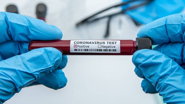 Laboratory technician hand hold on positive blood sample tube for corona virus test , COVID-19. Scientist with blue gloves for protection. Vaccine research for the 2019-nCoV - Фото, изображение