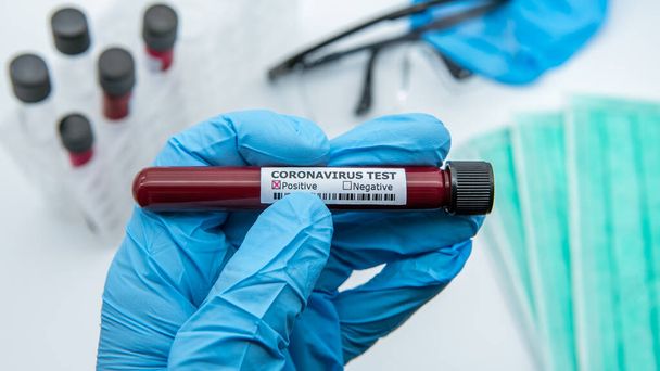Positive COVID-19 test and laboratory sample of blood testing for diagnosis new Corona virus infection. Disease 2019 from Wuhan. Pandemic infectious concept - Photo, image