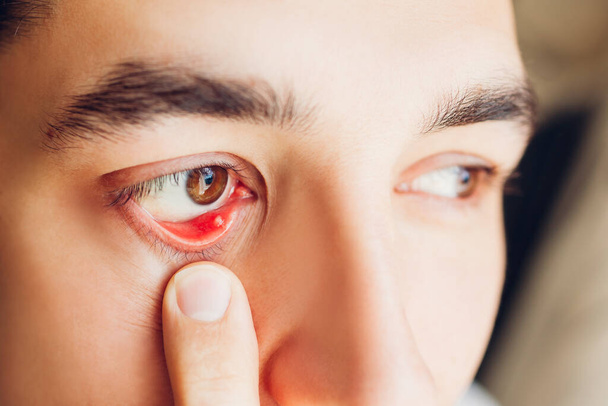 Infizierte Gerste eitriges Auge. Mann zieht unteres Augenlid herunter, das Eiter des Wimpernhaarbeutels zeigt, der durch Staphylococcus aureus verursacht wurde. Meibomit. Gesundheitsversorgung - Foto, Bild