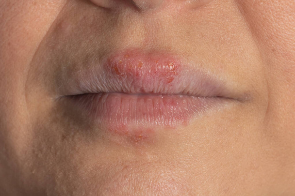 Allergic reaction to metal on the lips of a white woman - Photo, Image
