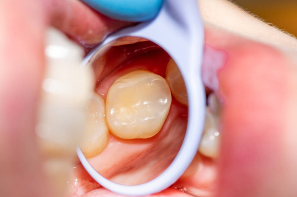 στενή-up θεραπεία ενός ανθρώπινου δοντιού χρησιμοποιώντας μπλε σύστημα rabberdam και ένα οδοντικό καθρέφτη. Αισθητική οδοντιατρική, υγιεινή - Φωτογραφία, εικόνα