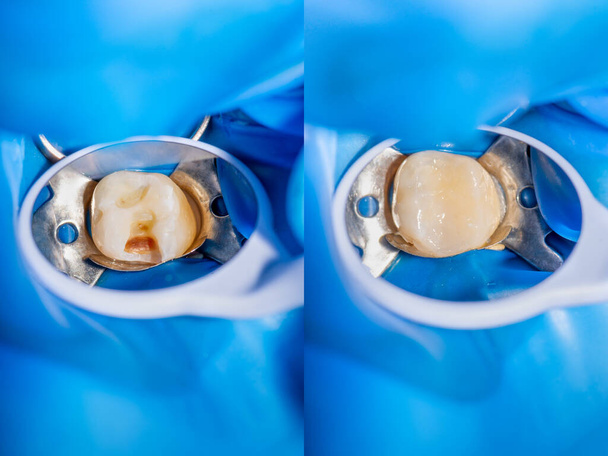 Des caries dentaires. Remplissage avec un matériau photopolymère composite dentaire à l'aide de lapins. Le concept de traitement dentaire en clinique dentaire
 - Photo, image