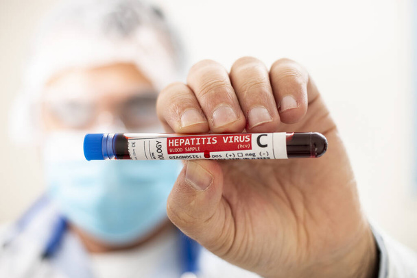 View of a doctor holding a fictional test tube blood sample, infected with Hepatitis C virus. - Photo, Image