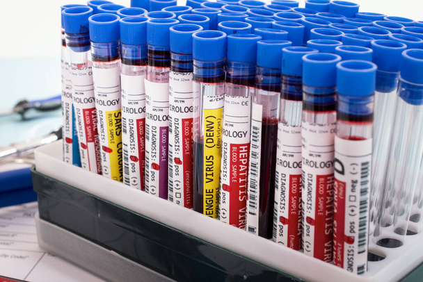 Varias muestras de sangre infectadas ficticias con varios virus en un bastidor del vial
. - Foto, Imagen