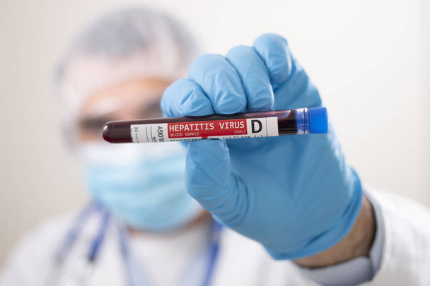 View of a doctor holding a fictional test tube blood sample, infected with hepatitis D virus. - Photo, image