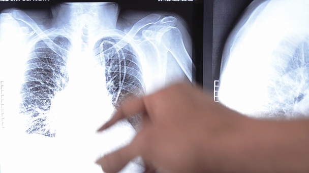 lekarz bada zdjęcie rentgenowskie klatki piersiowej człowieka - Materiał filmowy, wideo