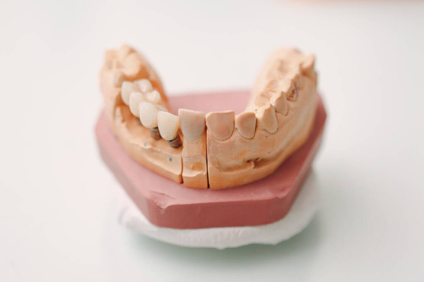 Układ stomatologiczny szczęki ludzkiej z zębami i implantami. - Zdjęcie, obraz