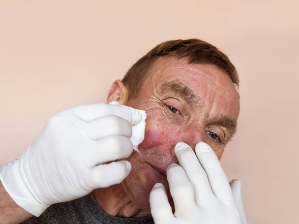 Demodecosis of the face. A man in gloves does the treatment of facial skin with medications. Prevention and treatment of skin diseases. - Photo, Image
