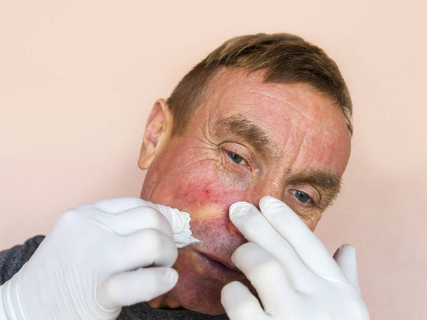 Demodecosis of the face. A man in gloves does the treatment of facial skin with medications. Prevention and treatment of skin diseases. - Photo, Image