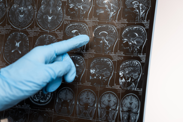 Vista recortada del médico que apunta a la resonancia magnética del cerebro aislado en el concepto de enfermedad de Alzheimer blanca
  - Foto, Imagen