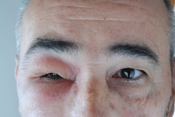 Face of middle aged man with swollen eye from the sting of the wasp, visible necrosis around the injection site, close up - Photo, Image