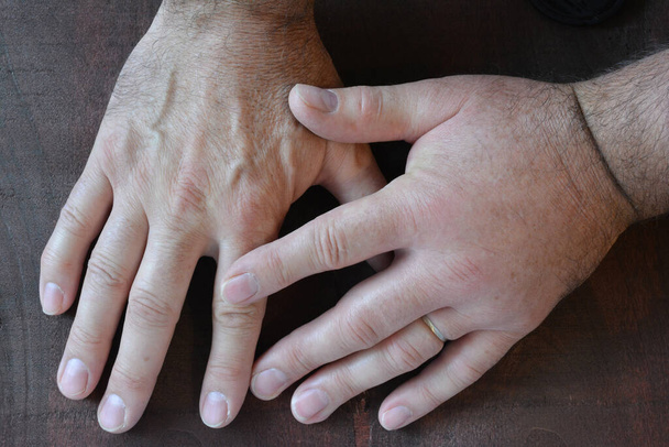 A swollen fist from a sting of a wasp compared to a healthy fist over dark wooden background, close up view - Photo, Image