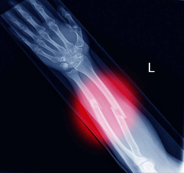Imagem de raios-X mostrando raio de fratura e ulna tecido mole inchaço na marca coloe vermelho.Conceito de cuidados de saúde
. - Foto, Imagem