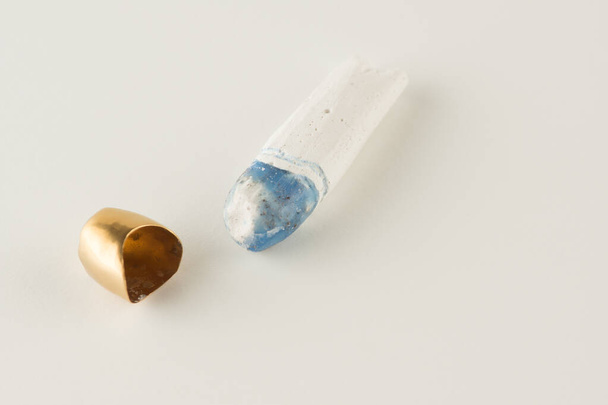 Χάλυβα τεχνητή οδοντιατρική στεφάνη για την αποκατάσταση της οδοντοστοιχίας - Φωτογραφία, εικόνα