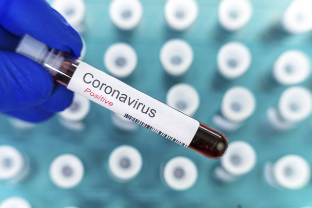 健康労働者は、コロナウイルス検査の肯定的な結果を示す1つの検査管を保持している。背景として特別なホルダーの多くの血液チューブテスト. - 写真・画像