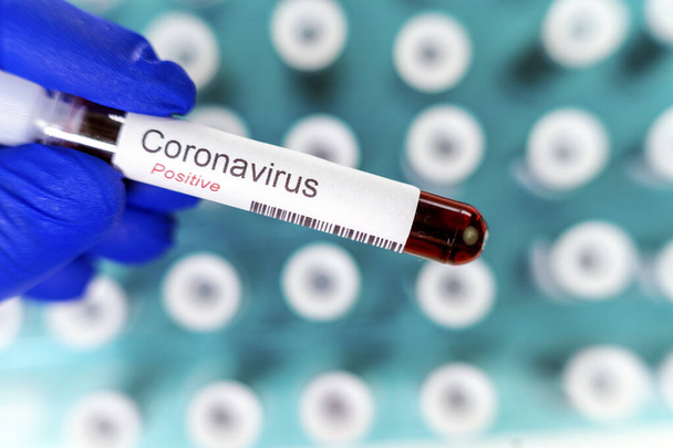 Zdravotník má jednu zkumavku, která ukazuje pozitivní výsledky testu na virus korony. Mnoho krevní trubice-testy ve speciálním držáku jako pozadí. - Fotografie, Obrázek