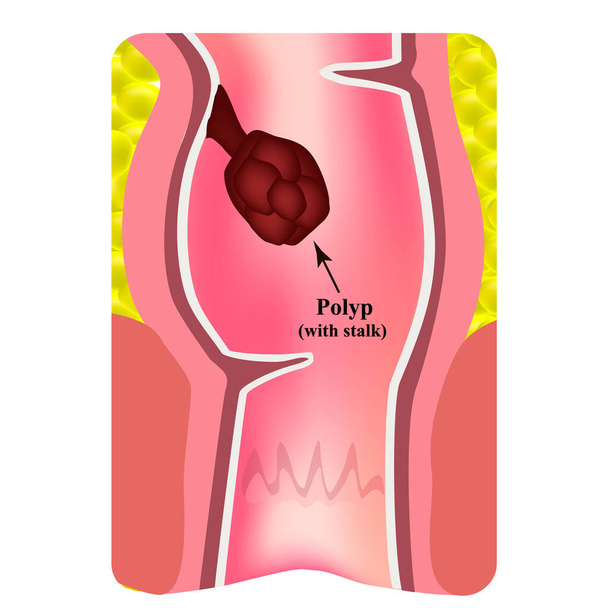 Polyps in the rectum. The structure of the rectum of the intestine. Types of polyps in the colon. Infographics. Vector illustration on isolated background. - Vector, Image
