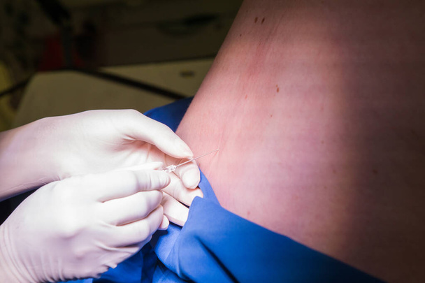 Immagine ravvicinata di un medico che esegue un blocco spinale epidurale per una donna incinta
 - Foto, immagini