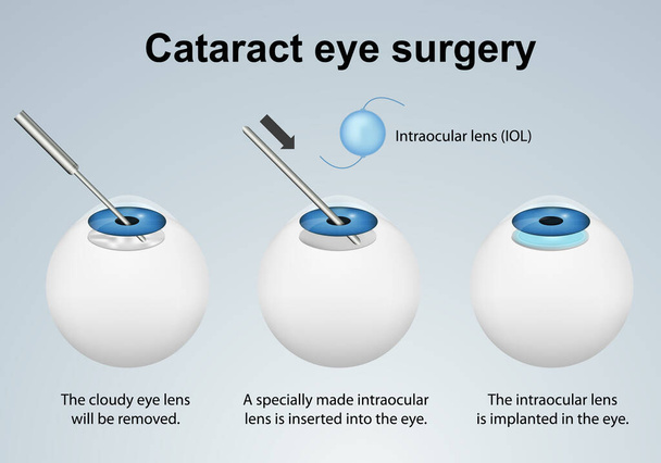 Иллюстрация вектора анатомии глазной катаракты с описанием на английском языке
 - Вектор,изображение