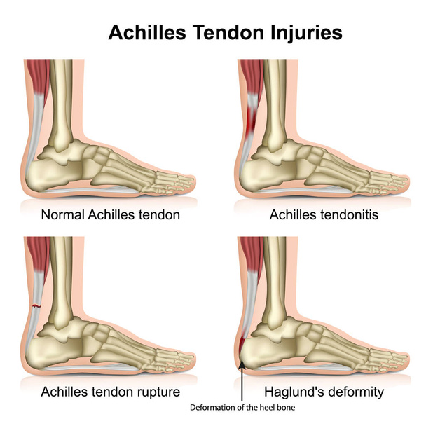 Achilles pees verwondingen medische vector illustratie geïsoleerd op witte achtergrond met Engels beschrijving eps 10 infographic - Vector, afbeelding