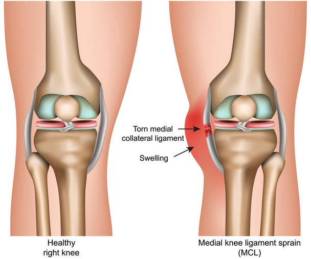 Esguince medial de ligamento de rodilla ilustración vectorial médica aislada sobre fondo blanco infografía
 - Vector, imagen