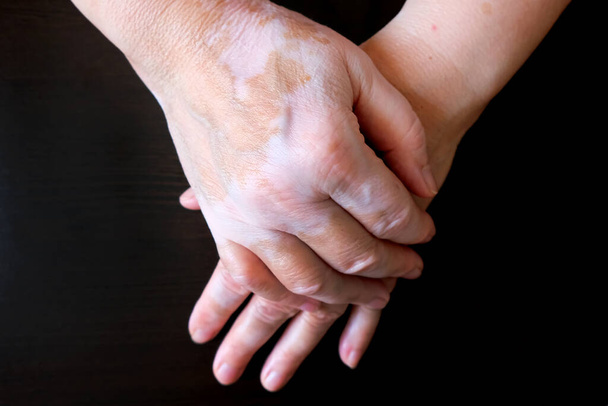 Les mains de la femme sont pliées. La peau est tachée de vitiligo. Vitiligo sur les mains d'une femme âgée
. - Photo, image