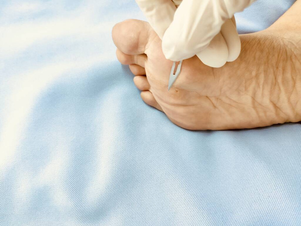 Docteur Checking, Traiter et guérir la verrue sous le pied, traitement par l'acide salicylique. verrue sur une partie du corps gel verruqueux, soins de santé et concept médical
. - Photo, image