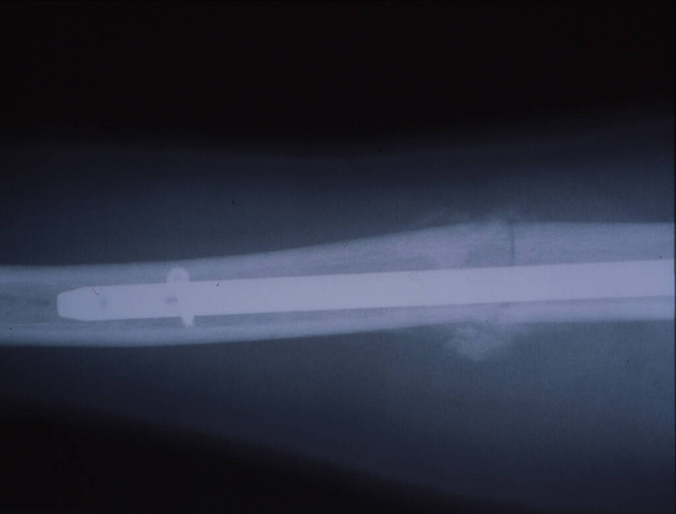 Рентген кости, прибитой после несчастного случая
 - Фото, изображение