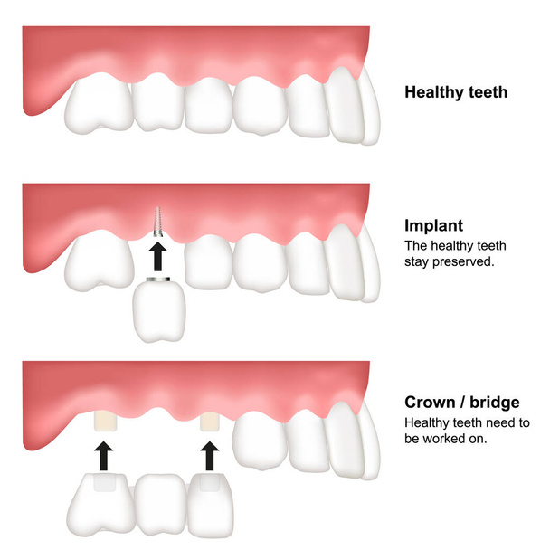 Zahnersatz zahnmedizinische Vektor Illustration isoliert auf weißem Hintergrund - Vektor, Bild