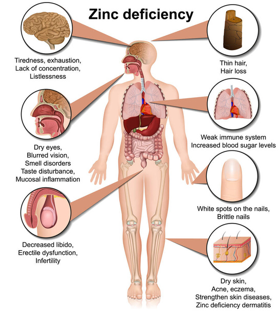 zinc deficiency 3d medical vector illustration isolated on white background infographic - Vector, Image