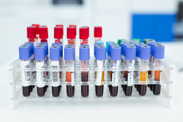 Coronavirus blood test concept. Analyzing blood sample in test tube for coronavirus test. Tube with blood for 2019-nCoV or COVID-19 test. - Foto, afbeelding
