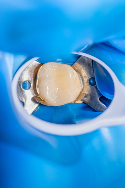 traitement en gros plan d'une dent humaine à l'aide d'un système de rabberdam bleu et d'un miroir dentaire. Dentisterie esthétique, hygiène
 - Photo, image