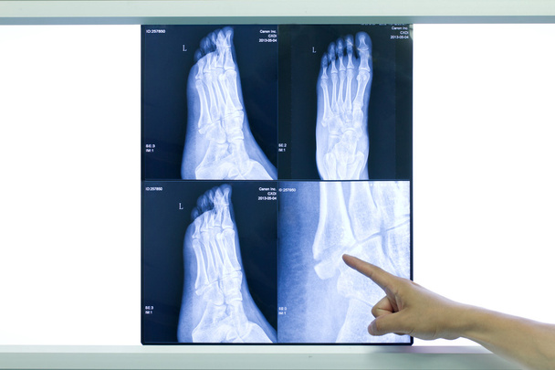 Radiografía del pie
 - Foto, Imagen