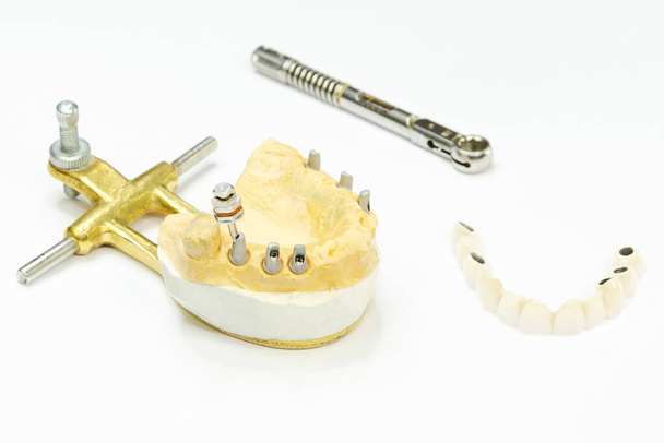 the process of manufacturing ceramic teeth on implants. dental implants with ceramic teeth on a light background. concept of dental implantation and dental prosthetics on implants. - Photo, Image