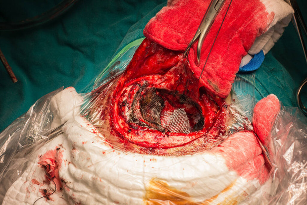 craniotomie bij spoedeisende hulp - Foto, afbeelding