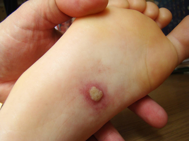Herpis on the baby's leg is a disease with a characteristic close-up photo rash - Photo, Image