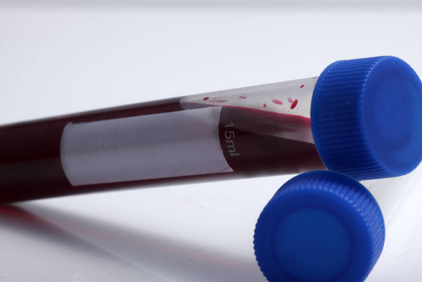 Amostra de sangue do paciente colocada no tubo de ensaio para análise e teste em laboratório
 - Foto, Imagem