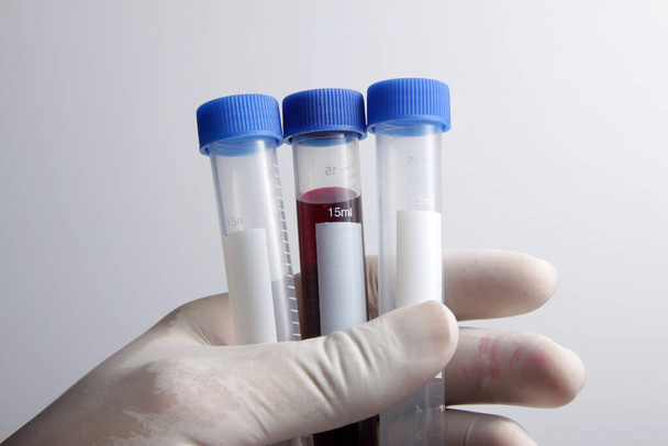 Δείγμα αίματος από ασθενή τοποθετημένο σε δοκιμαστικό σωλήνα για ανάλυση και δοκιμή στο εργαστήριο - Φωτογραφία, εικόνα