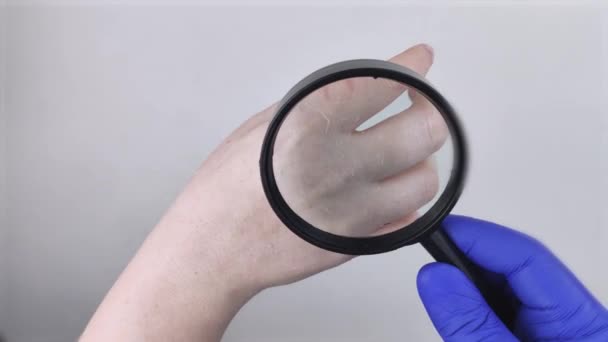 皮膚科医は虫眼鏡で乾燥肌を調べます。乾燥した手と皮膚の剥離,真菌症.少女は医者の皮膚科医に手を見せる。手を湿らせ、指で真菌を治療する - 映像、動画