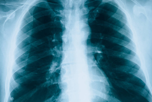 Rayos X de pulmones. Fluorografía. Revisando pulmones en el hospital. Instantánea real de los pulmones humanos de rayos X
 - Foto, imagen