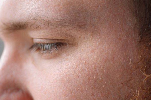 Milia (Milium) - puistjes rond het oog op de huid. Ogen van jonge man met kleine papillomen op oogleden of gezwellen op de huid - Foto, afbeelding