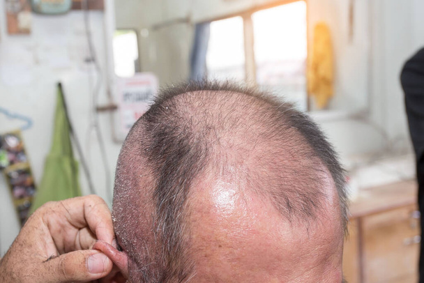 közeli felvétel a férfiakról, akiknek súlyos hajhullási problémájuk van. A pikkelysömör egy autoimmun betegség, amely a bőrt érinti, bőrgyulladást okoz, vörös és pikkelyes. - Fotó, kép