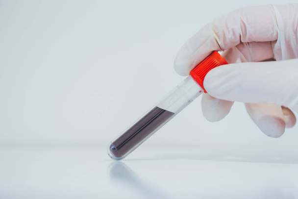 Positive Covid-19 test. Coronavius outbreak crisis. Blood sample in a tube at lab.  - Φωτογραφία, εικόνα