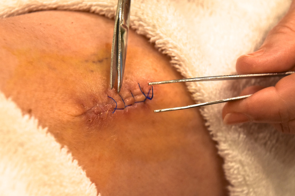 Les pinces sont utilisées pour enlever la suture d'une blessure à une jambe
. - Photo, image