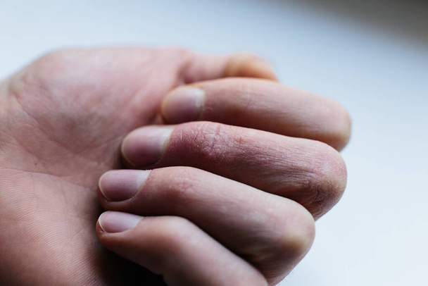 Hombre con manos enfermas, piel seca y escamosa en la mano con psoriasis vulgar, eczema y otras enfermedades de la piel como hongos, placa, erupción y manchas. Enfermedad genética autoinmune
. - Foto, Imagen