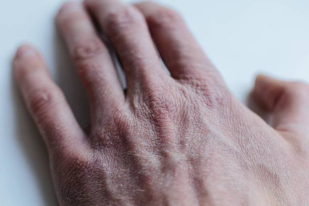 Mann mit kranken Händen, trockener schuppiger Haut an der Hand mit vulgärer Schuppenflechte, Ekzemen und anderen Hauterkrankungen wie Pilz, Plaque, Hautausschlag und Flecken. Autoimmunkrankheit. - Foto, Bild