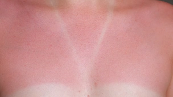 νεαρή γυναίκα γυμνή ηλιοκαμένο κόκκινο στήθος και το λαιμό closeup - Πλάνα, βίντεο