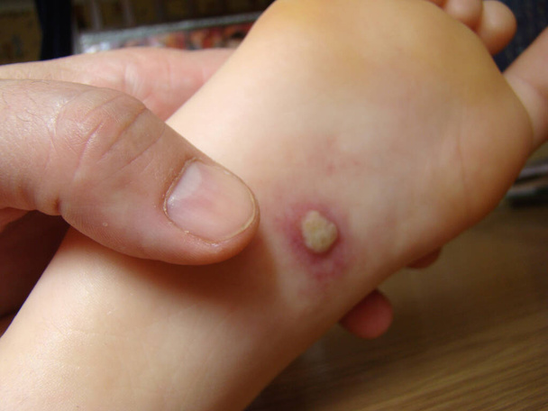 Herpis am Bein des Babys ist eine Krankheit mit einem charakteristischen Hautausschlag in Großaufnahme - Foto, Bild